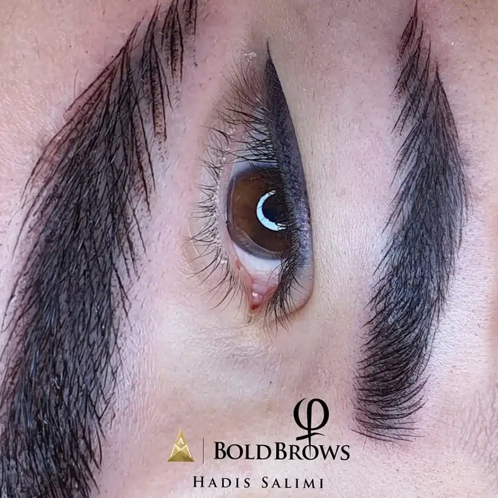 میکروبلیدینگ