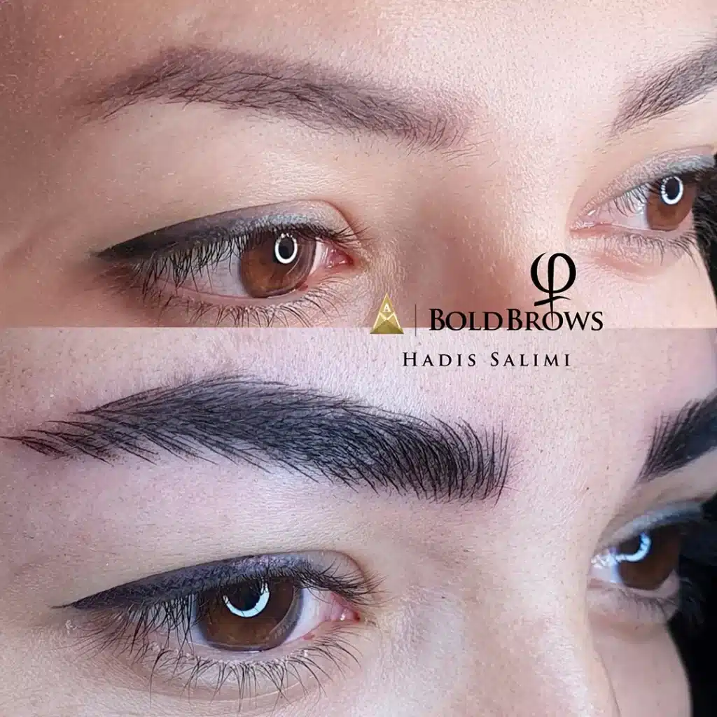 میکروبلیدینگ