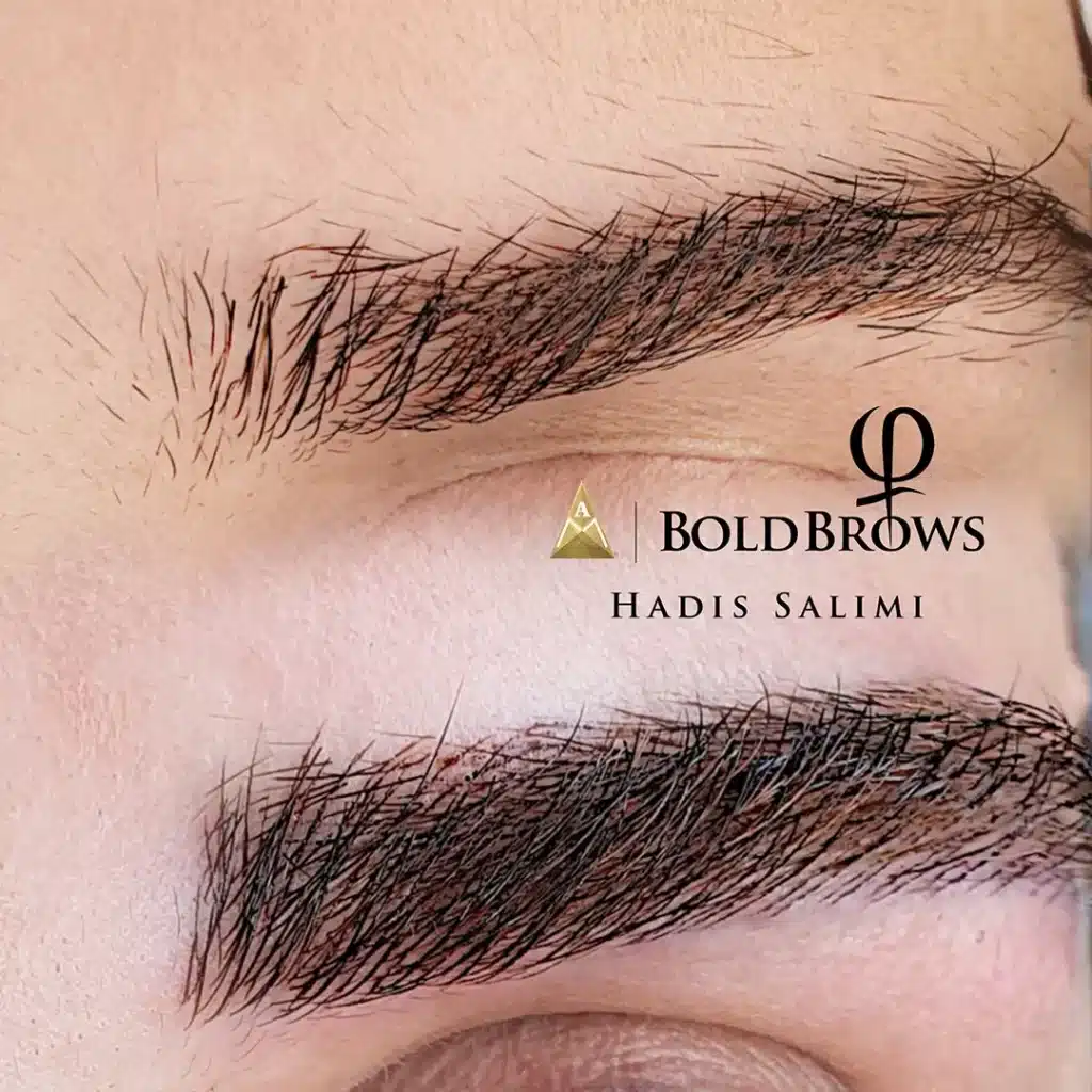 میکروبلیدینگ